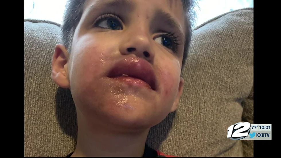 A Texoma boy is recovering after something meant to protect him left him with burns on his face. How a trip to the grocery store quickly turned into a trip to the doctor.